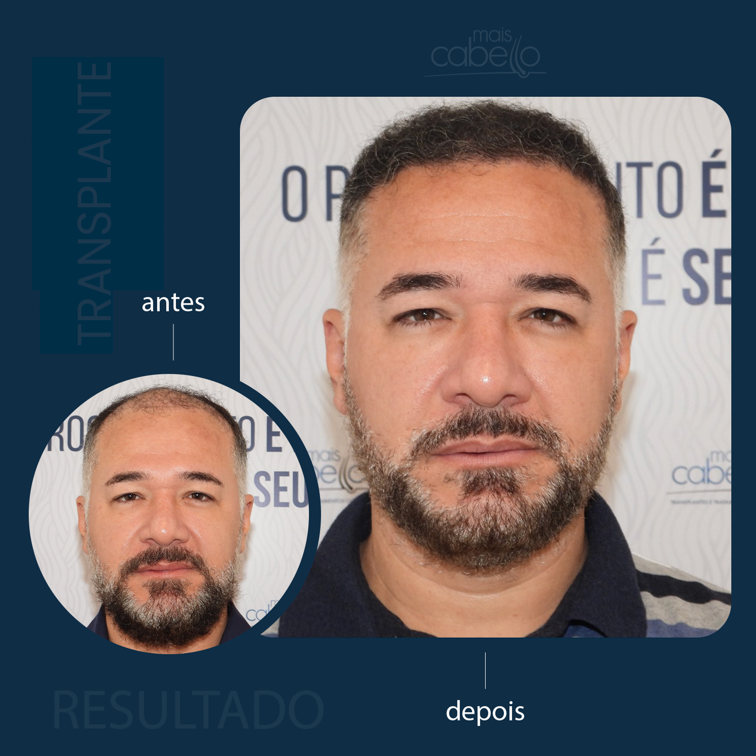 Antes e Depois - Transplante Capilar Masculino