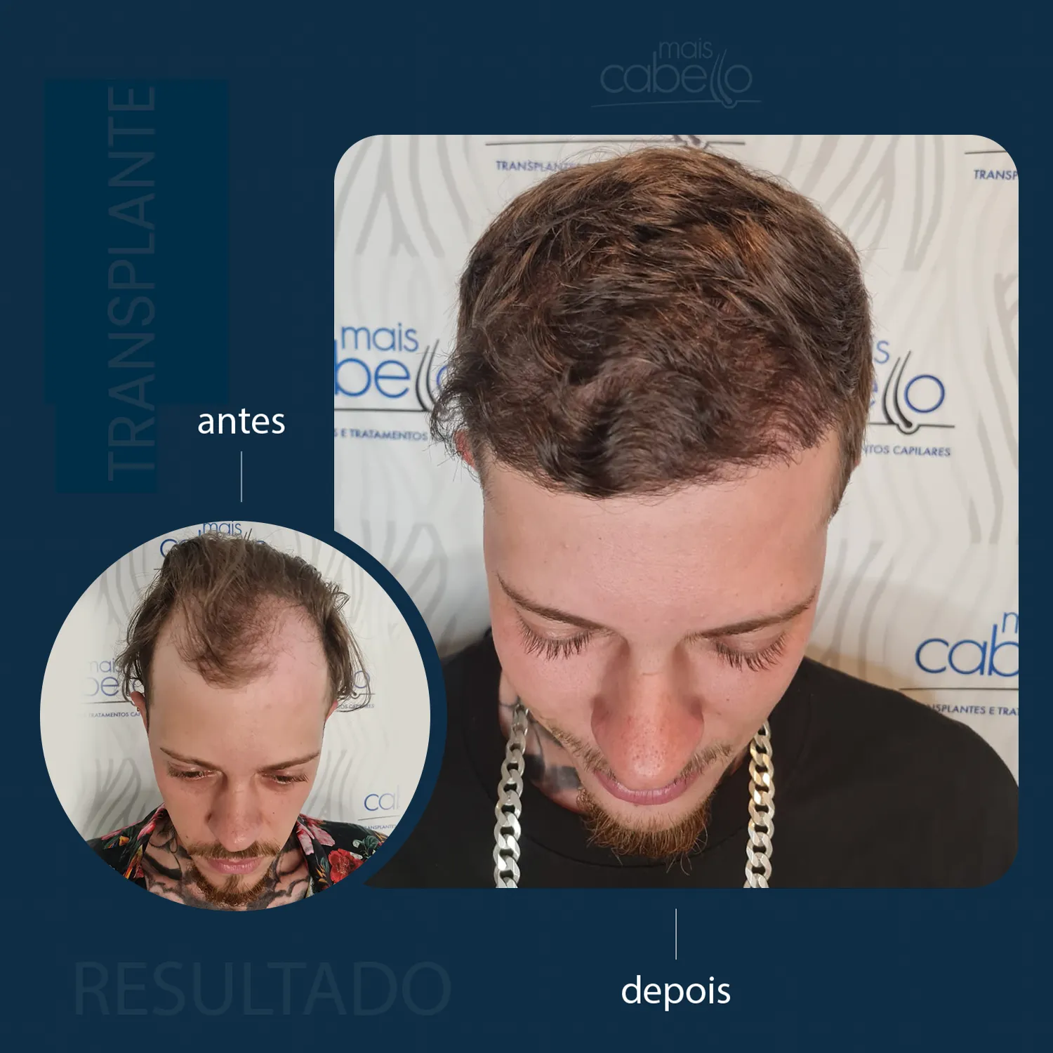 Antes e Depois - Transplante Capilar
