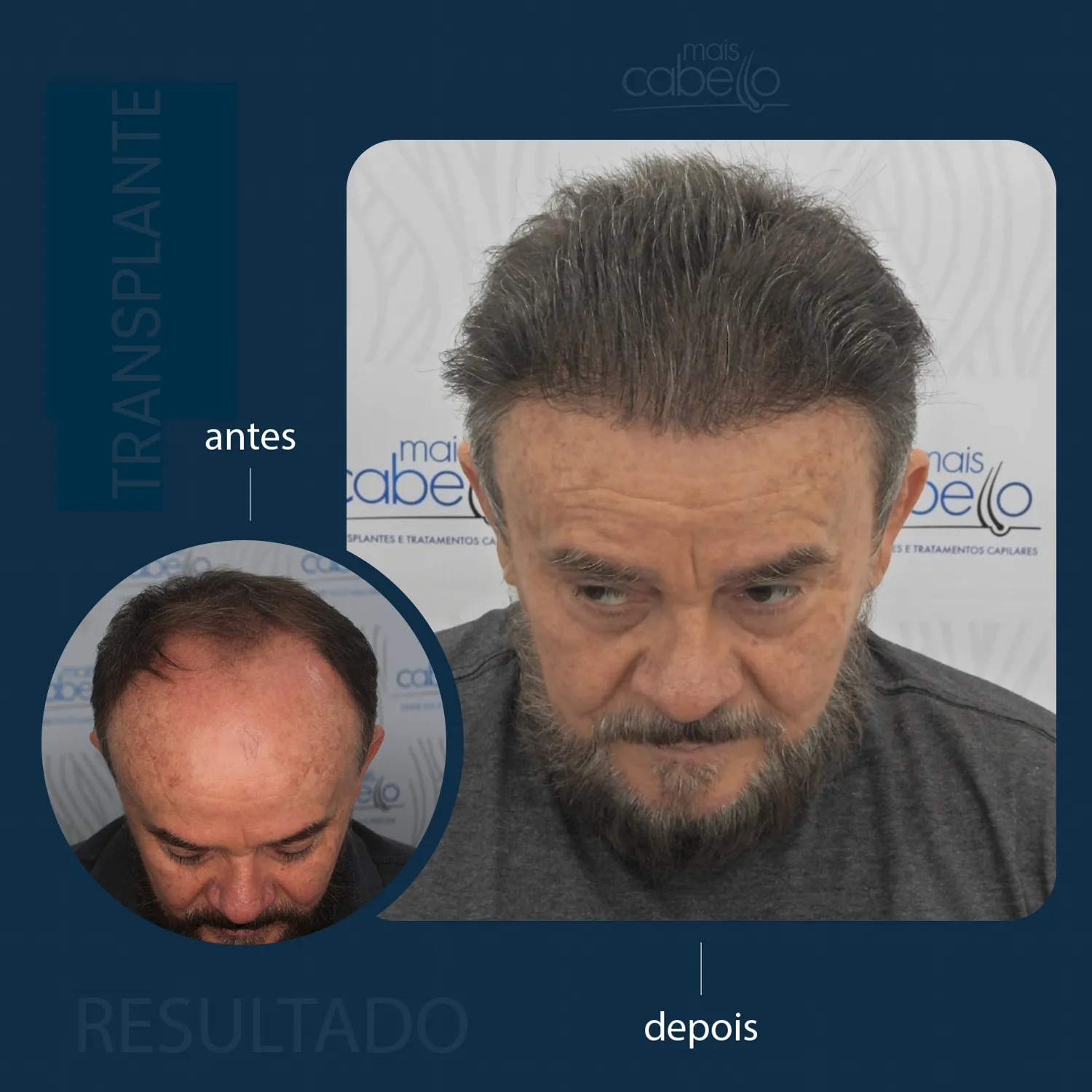 Antes e Depois - Transplante Capilar