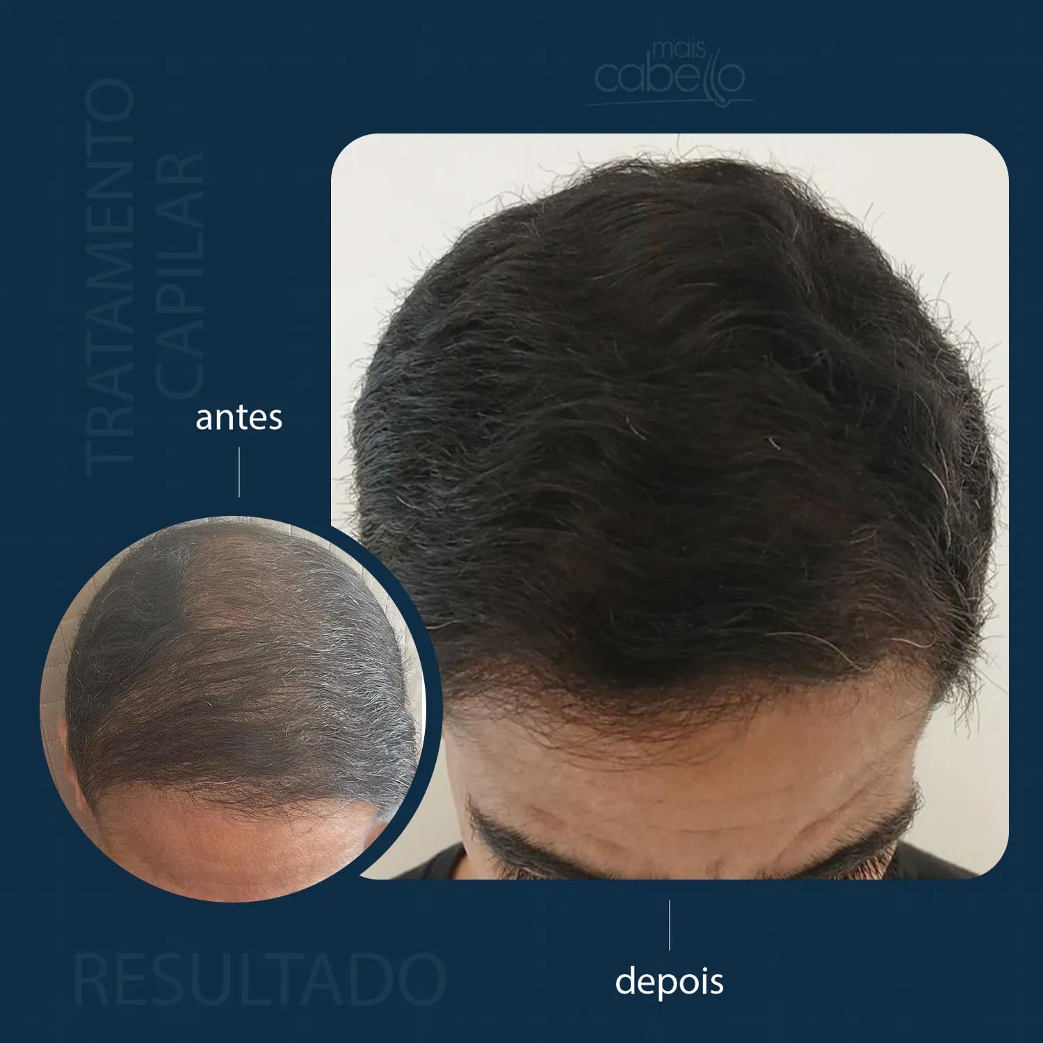 Antes e Depois - Resultado Capilar Masculino