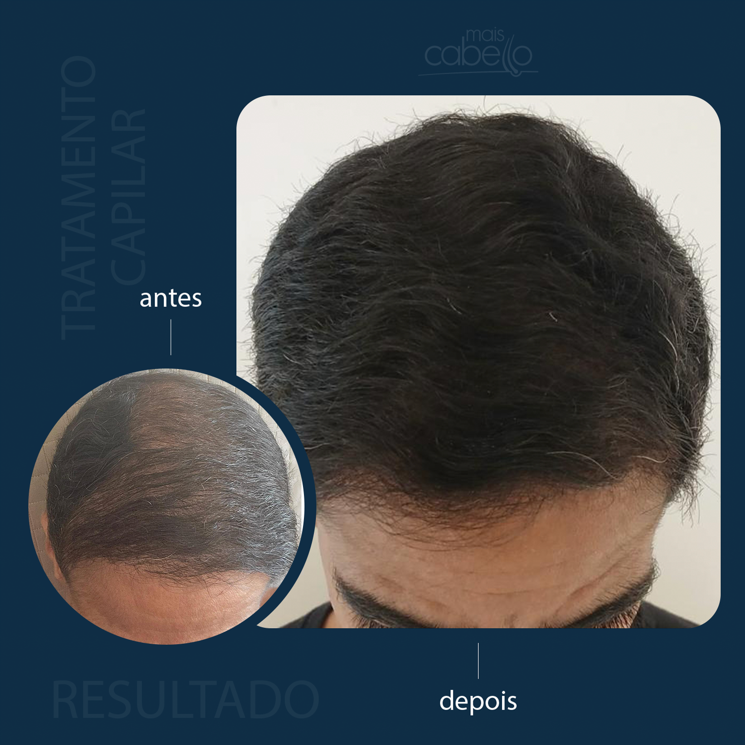 Antes e Depois - Resultado Capilar Masculino