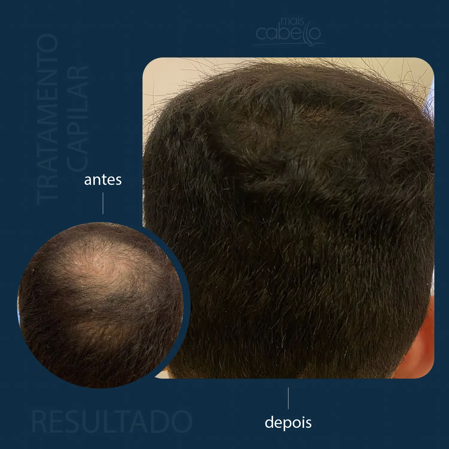 Antes e Depois - Evolução Capilar Masculina