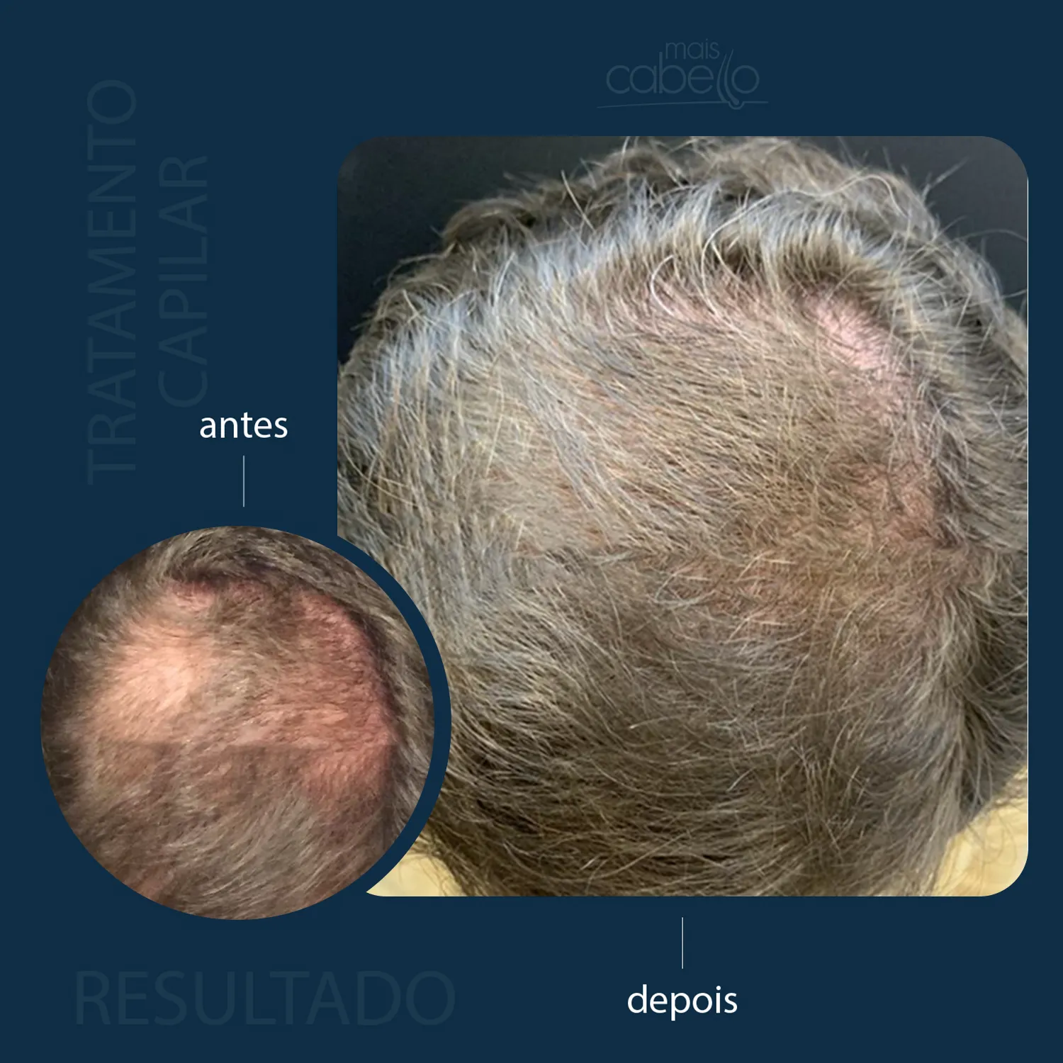 Antes e Depois - Resultado Capilar Masculino