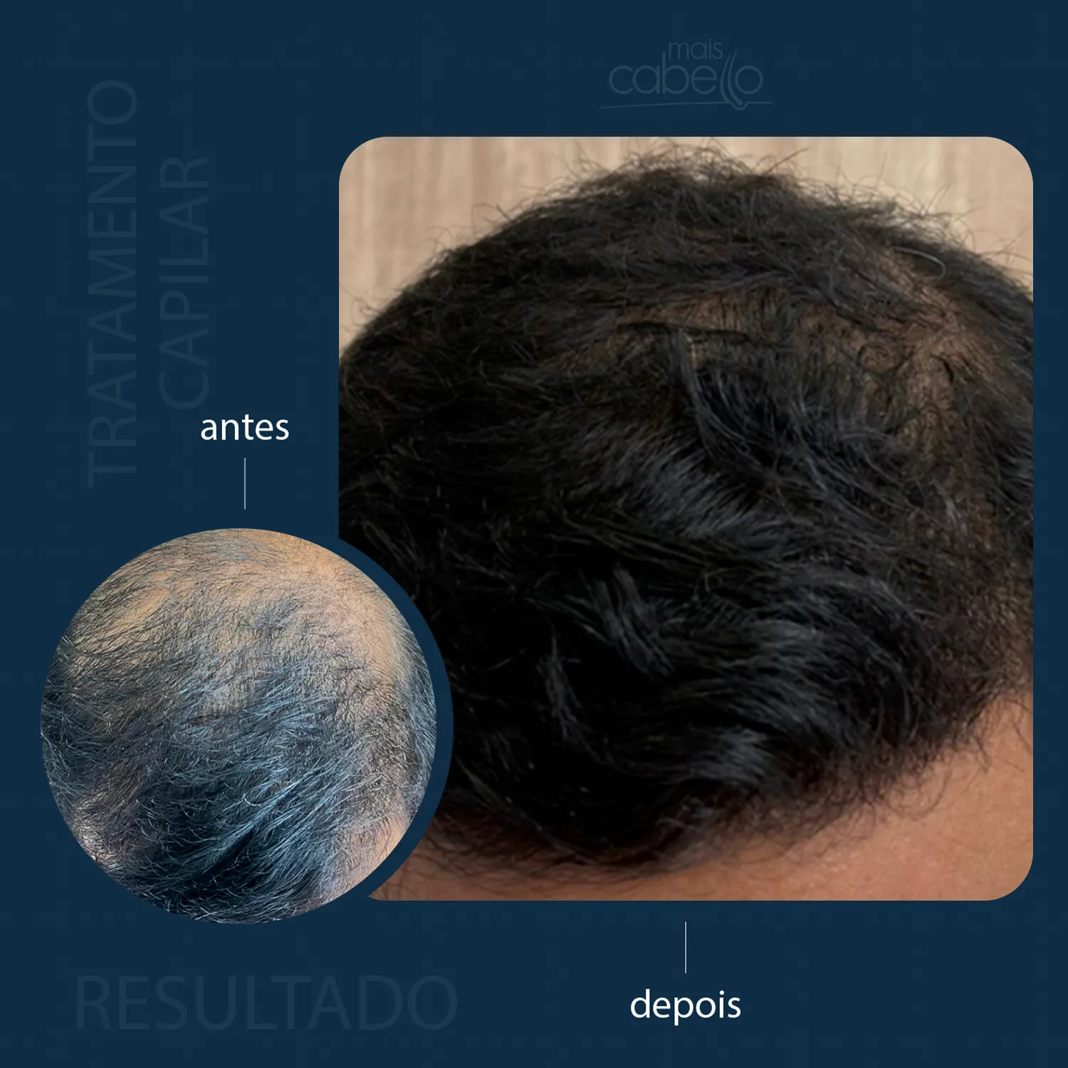 Antes e Depois - Evolução Capilar Masculina